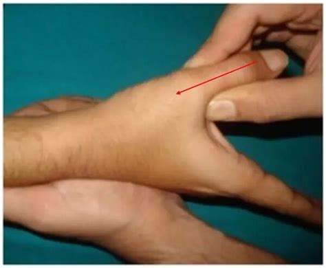 schaphoid compression test evidence|scaphoid instability test.